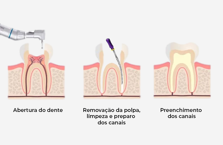 Tratamento de Canal